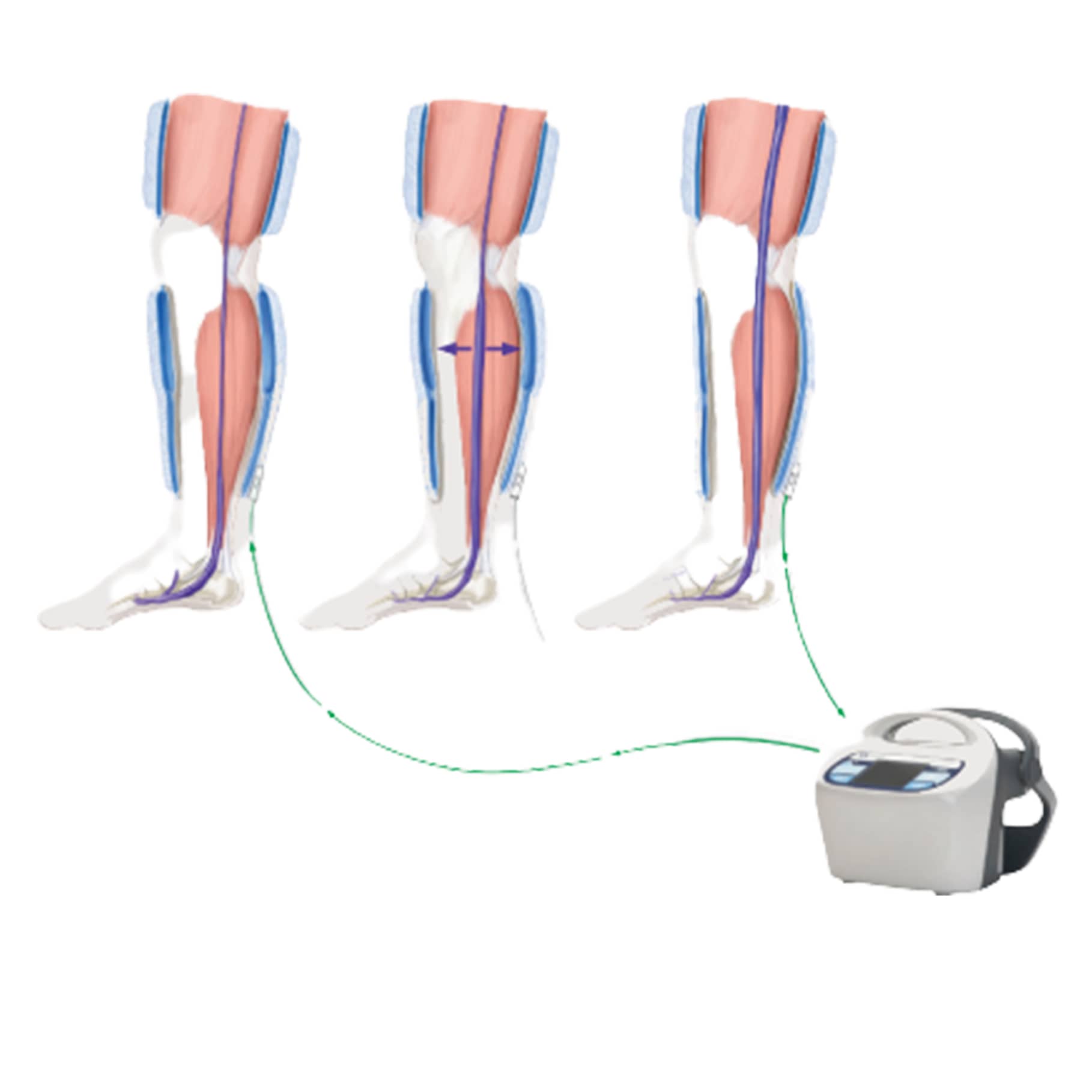 Kendall SCD 700 Controller Ambulatory Tubing Extension Assembly Diagram