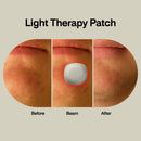 LAB Acne Light Therapy Patch Acne Treatments with Lightpod and Four Hydrogrips (96/CS)