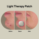 LAB Acne Light Therapy Patch Acne Treatments w/ 2 Lightpods, 8 Hydrogrips, Case