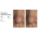 Foreo Inc KIWI Blackhead Remover Pore Vaccum 