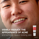 Neutrogena Rapid Clear Stubborn Acne Spot 10% Benzoyl Peroxide Gel, 1 ounce (Each)