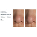KIWI Blackhead Remover Pore Vaccum (Each)