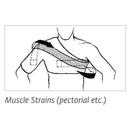 Chattanooga Sully Shoulder Stabilizer - Pectoral Muscle Strain Demo