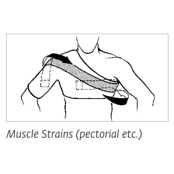 Chattanooga Sully Shoulder Stabilizer 