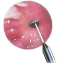 ConMed Esophageal Balloon Dilator Advantage Pack in use