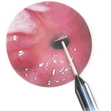 ConMed Esophageal Balloon Dilator Advantage Pack in use