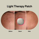 LAB Acne Light Therapy Patch Acne Treatments with Lightpod and Four Hydrogrips