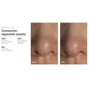 Foreo Inc KIWI Blackhead Remover Pore Vaccum