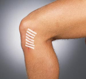 Gentell Suture Strip Wound Closure Strips