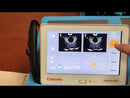 Caresono PadScan HD3 Bladder Scanner Tutorial video
