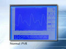 Summit Doppler Vista Obtaining Pressures and Waveforms video