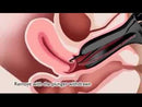 Wallach Endocell Endometrial Cell Sampler