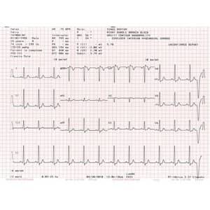 Schiller MS-2010 Chart Paper  Case of 25 Packs