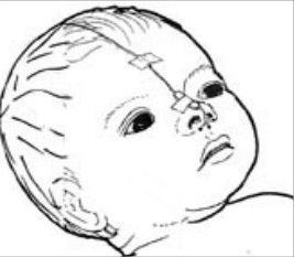 SleepSense Infant Thermal Flow Sensor